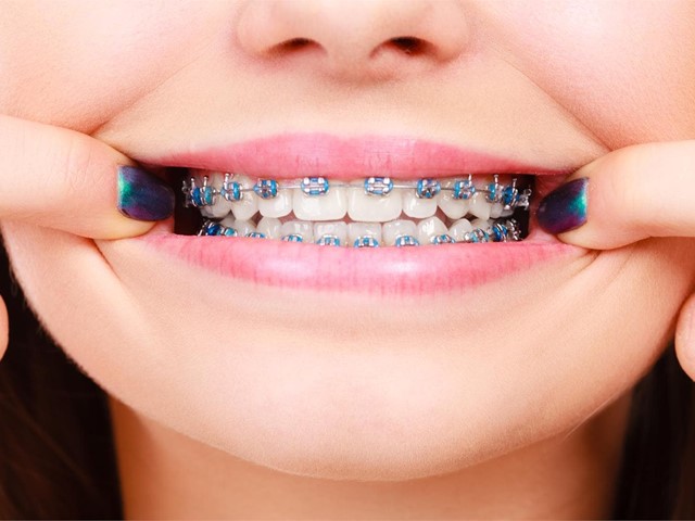 ¿Cómo limpiar correctamente los brackets? Consejos prácticos para pacientes con ortodoncia