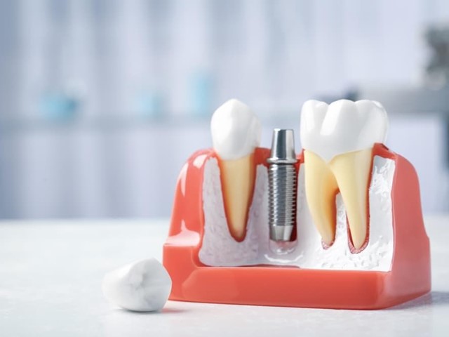 Descubre las ventajas de las prótesis dentales fijas y removibles