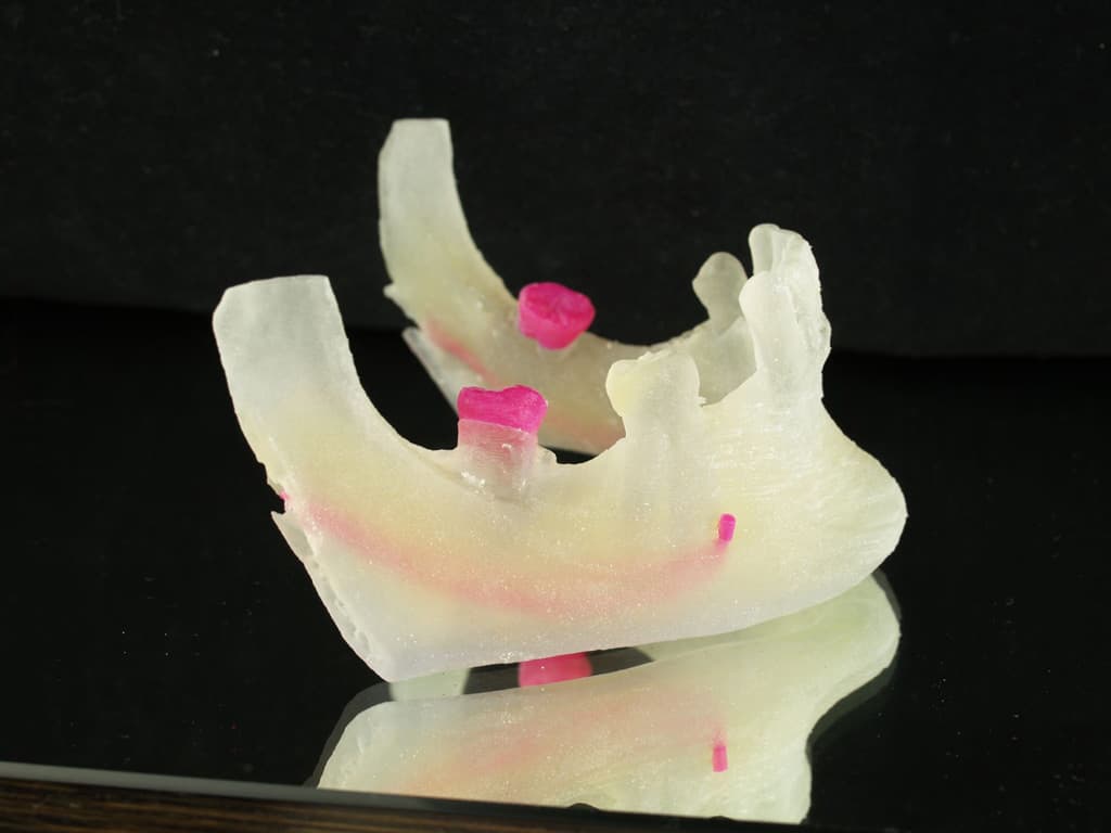 Implantes de dientes en Vigo