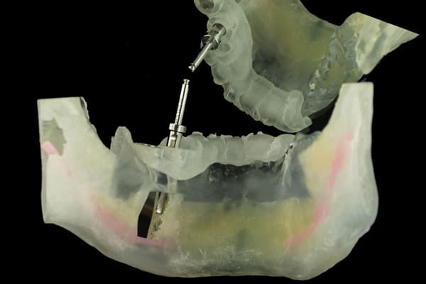 Implantes de dientes en Vigo