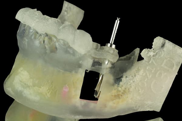 Implantes de dientes en Vigo
