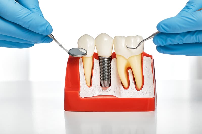 Implantes dentales